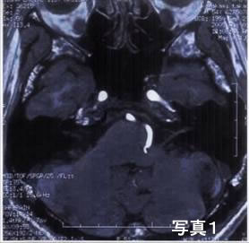 写真1:MRI画像